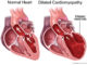 Looking for the source of dilated cardiomyopathy gene appear breakthroughs
